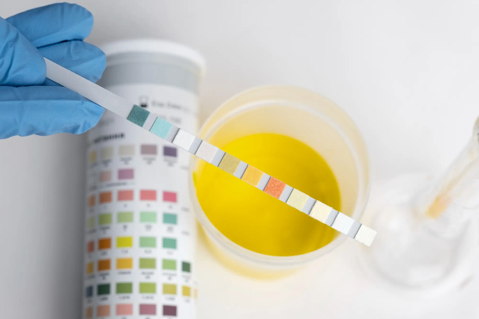 Urine Culture Test at Home Service In Dubai