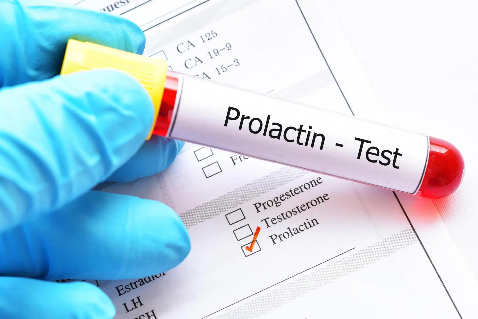 Prolactin Test at Home In Dubai